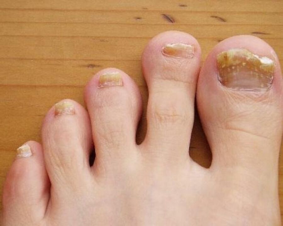 Gelbfärbung der Nagelplatte durch Pilzbefall