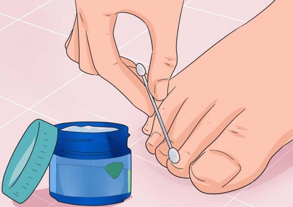 Anwendung von Salben zur Behandlung von Nagelpilz