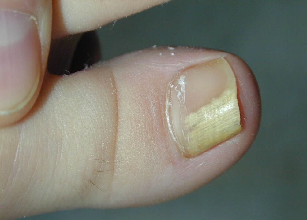 Pilzinfektion der Nagelplatte