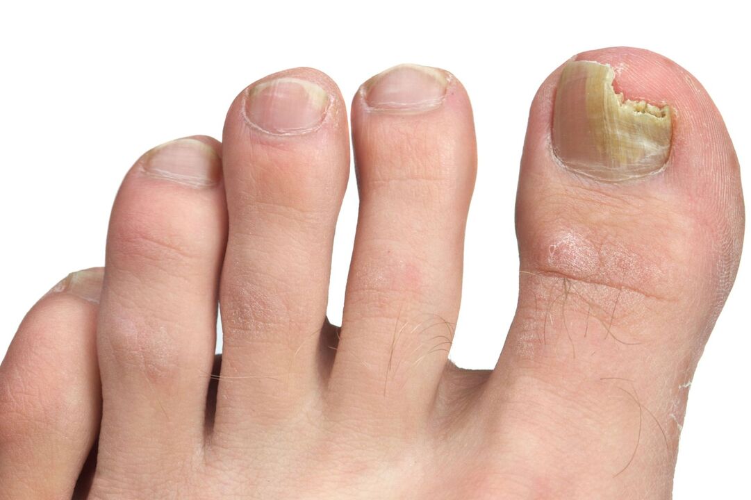 symptome nagelpilz