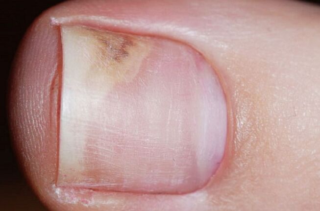 Anzeichen einer Onychomykose im Anfangsstadium - mangelnder Glanz, eine Lücke zwischen Nagel und Nagelbett