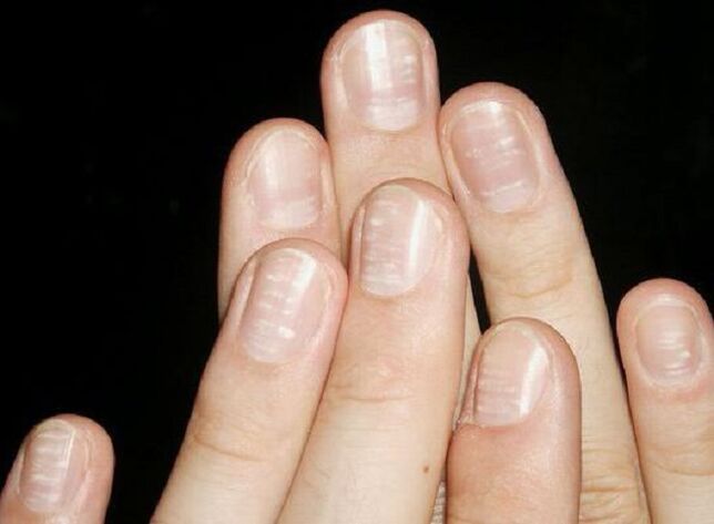 Weiße Flecken auf den Fingernägeln sind ein Zeichen für die Entwicklung eines Pilzes