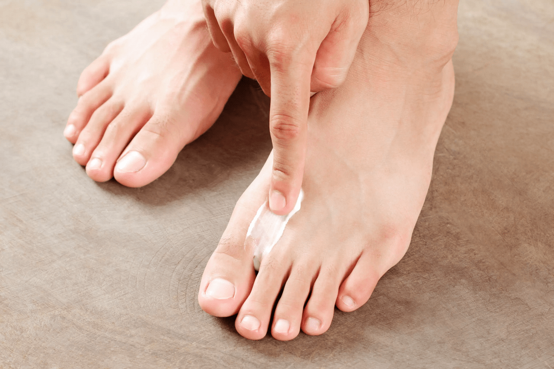 Auftragen einer antimykotischen Salbe auf die Haut des Fußes