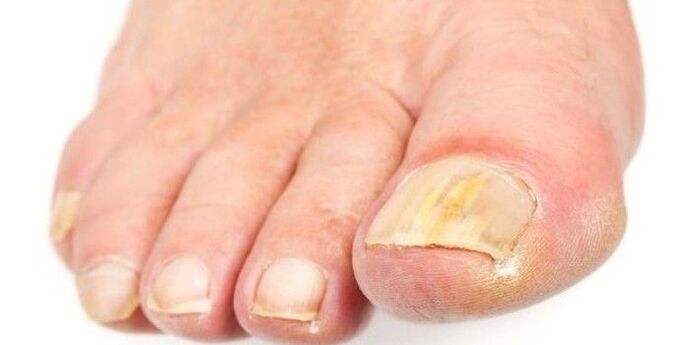 Nagelpilz