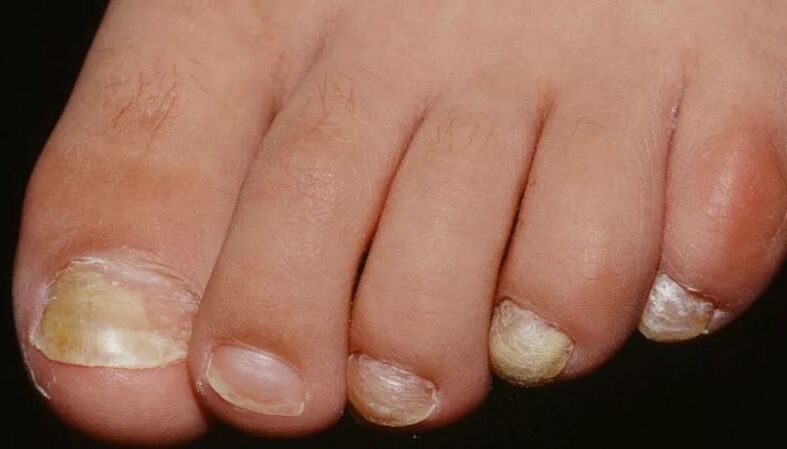Der Nagelpilz am Daumen