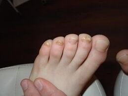 Nagelpilz geschieht auch bei Kindern