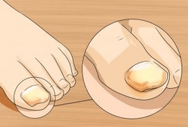 Nagelpilz