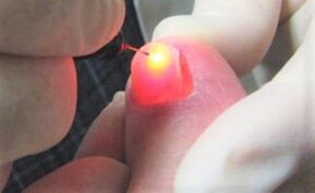Behandlung von Nagelpilz mit einem Laser