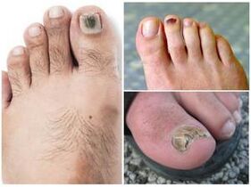 Nagelpilz