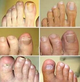 Verformung des Nagels