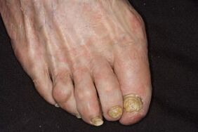 Behandlung von Nagelpilz an den Beinen Apfelessig
