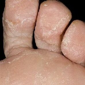 Stadien des Nagelpilzes