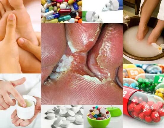 Interdigitalmykose und Behandlungsmethoden