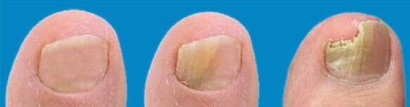 Pilzentwicklungsprozess