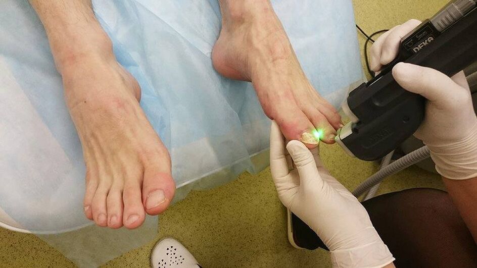 Lasertherapie bei Nagelpilz