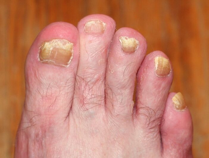 fortgeschrittene Form des Nagelpilzes