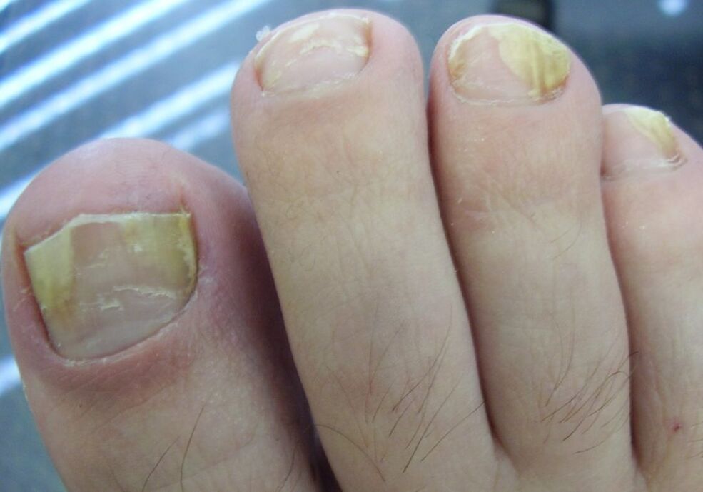 Gelbe Farbe der Nagelplatte im zweiten Stadium der Pilzinfektion