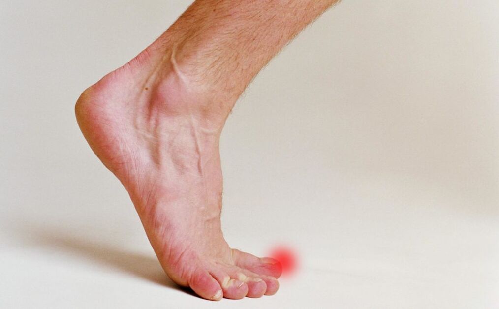 Nagelpilz am großen Zeh