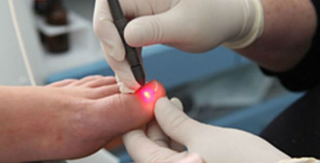 Lasertherapie bei Zehennagelpilz